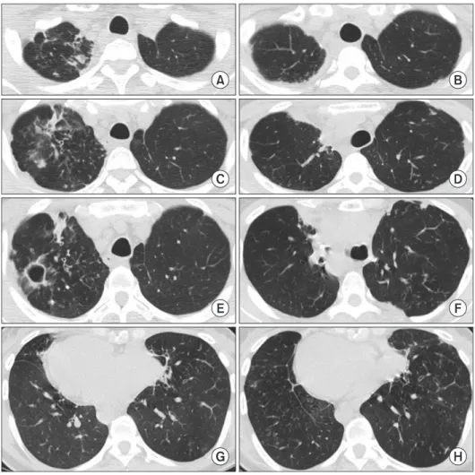 Figure 3. (A, C, E, G) At 9 months after the  left-sided surgery, chest high-resolution  computed tomography showed an  aggra-vation of the cavitary lesion in the right  upper lobe