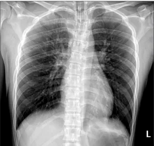 Figure 2. At day 5 after the initiation of valproic acid, chest radiography revealed bilateral consolidation in both lower lung fields (A)