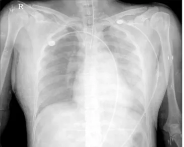 Figure 1. The plain chest radiography shows ground glass opacity  and consolidation in both lung fields.
