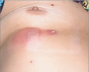 Figure 1. Skin lesions. Pink erythematous, cold, soft, tender sub- sub-cutaneous mass of 6×3 cm size are noted on the right chest wall  between the fifth and seventh ribs.