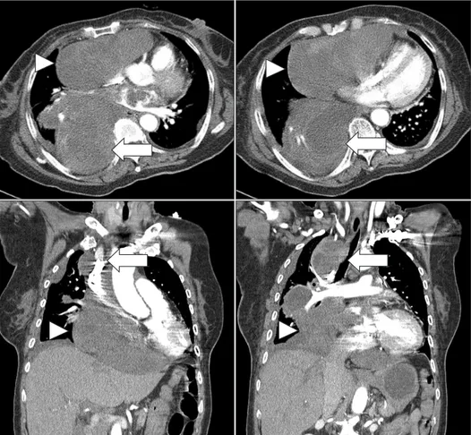 Figure 6. The chest computed tomogra- tomogra-phy scan observed increased right hilar  and subcarinal mass (arrows)  compress-ing the superior vena cava, increased  right mediastinal mass compressing the  right atrium and right ventricle  (arrow-heads), an