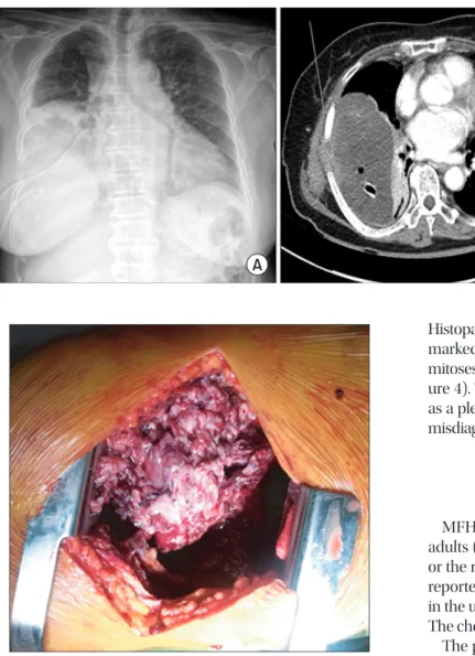 Figure 3. A very large mass protruded into the thorax, which invad- invad-ed and damaginvad-ed the encounterinvad-ed rib.