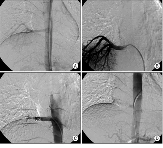 Figure 3. (A, B) Angiography showing an  large anomalous systemic artery from  the descending aorta which supplies the  segment of the right lower lobe
