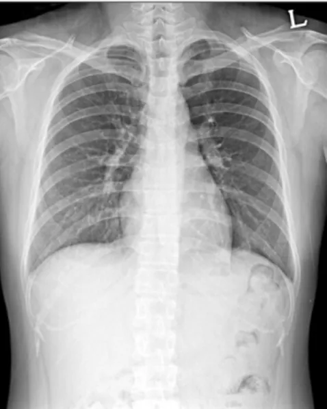 Figure 2. (A) Chest computed tomography (CT) scan performed on 4th day of menstruation shows focal consolidation with surrounding ground  glass opacity in the posterior basal segment of the left lower lobe
