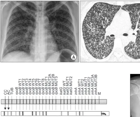 Figure 3. A chest radiography after treatment showed resolution of  diffuse micro-nodules involving both lung fields