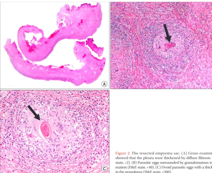 Figure 2. The resected empyema sac. (A) Gross examination  showed that the pleura were thickened by diffuse fibrosis (H&amp;E  stain, ×2)
