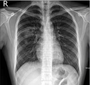 Figure 2. Non-enhanced chest computed  tomography (CT) images. (A) Initial  non-enhanced chest CT shows a 5-cm  cavi-tary consolidation in the right upper lobe  posterior segment