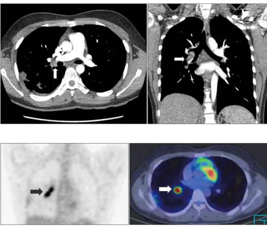 Figure 4. Positron emission tomography- tomography-computed tomography shows increased 