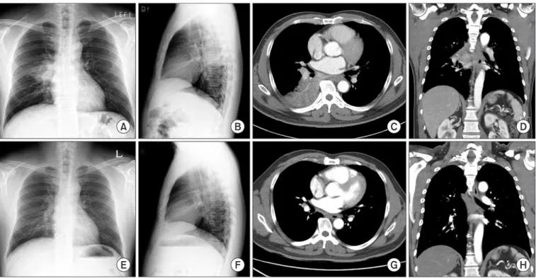 Figure 1. (A−D) Imaging study on admission day suggested obstructive pneumonia on superior segment of right lower lung (RS6)
