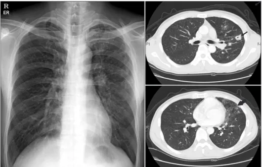 Figure 1. Chest X-ray and chest computed  tomography (CT) in case no. 3. Chest  X-ray revealed multiple small nodules and  patchy consolidations predominantly in  the left lung field, and the chest CT  re-vealed a cavitary nodule (thin arrow) and  tree-in-