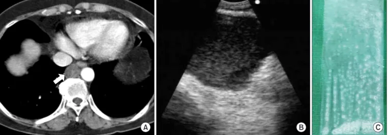 Figure 1. (A) Baseline computed tomography image of the chest showing a round, right lower paraesophageal lesion, of 2.3 cm in diameter,  with homogeneous and soft-tissue attenuation density (arrow)