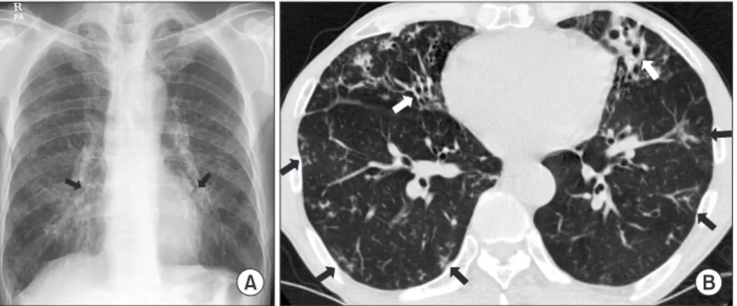 Figure 1. A 66-year-old male with bronchiectasis and nontuberculous mycobacterial lung disease caused by Mycobacterium abscessus sub- sub-sp