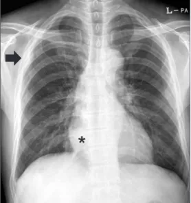 Figure 2. Chest computed tomography  scan showed a consolidative lesion at  right lower lobe (A) and a pleura-based  mass with contrast enhancement  sur-rounding normal lung parenchyma in  right upper lobe (B).