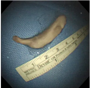 Figure 9. A 6-cm mass with smooth mucosal surface was extracted  from the left main bronchus.
