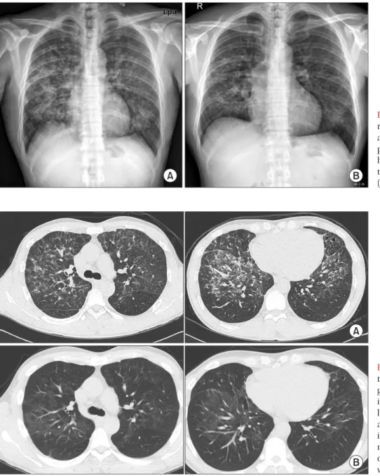 Figure  1.  Chest  X-ray  shows  bilateral  reticulonodular infiltration in both lungs  at admission (A) and slight regression of  peribronchial patchy opacities in both  lungs at 2 weeks after discontinuing  ima-tinib and commencing steroid treatment  (B)