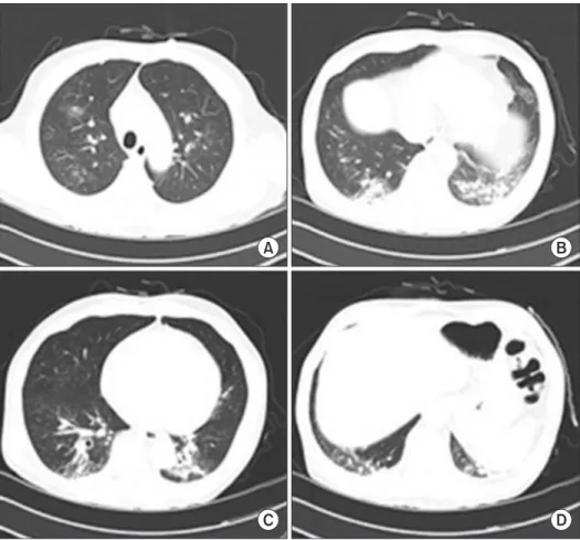 Figure 1. (A−D) Chest computed tomog- tomog-raphy findings. Multifocal ground glass  opacities and peribronchial infiltration in  both the lungs.