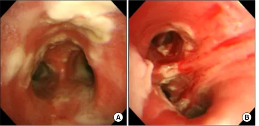 Figure 2. Bronchoscopic examination  showing mucosa hyperemia and wide,  raised and cream-colored plaques  (pseu-domembrane formation) through the  carina (A) and the right bronchus  inter-medius (B).