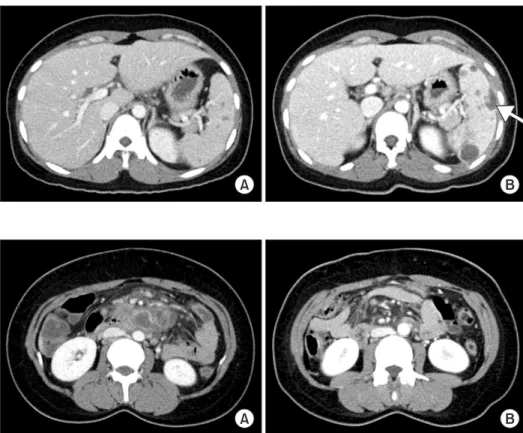 Figure 2. Computed tomography (CT)  findings of the abdomen. (A) Initial CT  shows several central low density with  peripheral rim enhanced lymph nodes  enlargement around small bowel  mesen-tery