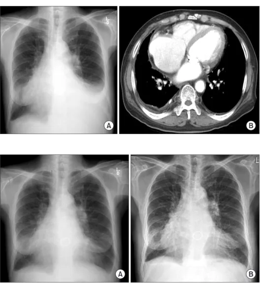 Figure 1. (A) Baseline chest X-ray image  shows blunting of the left costophrenic  angle