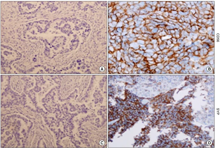 Figure 2. The expression of synaptophysin (SYP) and CD56 was increased in re-biopsied tumor tissues procured after development of erlo- erlo-tinib-resistance in a patient
