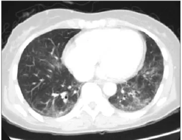 Figure 2. Chest computed tomography shows ground glass opacity  and reticular opacities in both lower lobes on admission