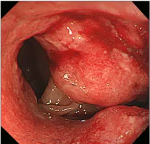 Figure 3. Colonoscopy shows about 3 cm sized circumferential ul- ul-cerative and fungating mass at anal verge 17−20 cm