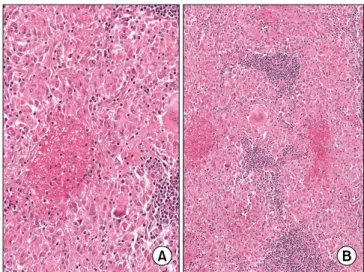 Figure 1. Sagittal (A) and axial (B) images  of enhanced neck computed tomography  (CT)