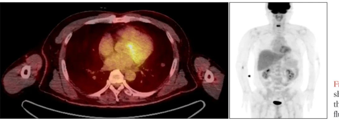 Figure 3. Surgical lung biopsy specimen showing the typical histo- histo-logical features of minute pulmonary meningothelial-like nodules