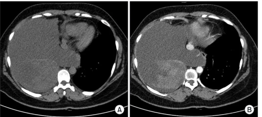 Figure 3. Video-assisted thoracoscopic view. A dumbbell-shaped,  whitish tumor was found in the posterior thorax wall.