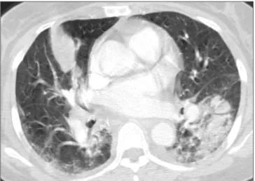 Figure 1. Chest computed tomography of a 66-year-old man with  community-associated methicillin-resistant Staphylococcus aureus  pneumonia shows consolidation and ground-glass opacity with  cavitation in the lower left lobe.