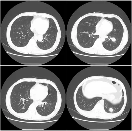 Figure 1. Initial chest radiography revealed two lung nod- nod-ules  in  lower  left  lung  field.
