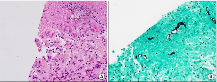 Figure 3. Pathological findings of lung tissue are shown as thick, irregular and non-septated fungal hyphaes with right-an- right-an-gle  branching  in  hematoxylin  and  eosin  stain  (A,  ×400)  and  Gomori's  methenamine  silver  stain  (B,  ×400).