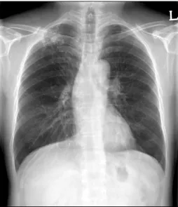 Figure  5.  After  the  end  of  the  treatment  for  3  months,  chest radiography revealed no definitive relapse of  mucor-mycosis.