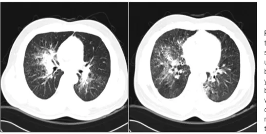 Figure  2.  Chest  computed  tomography  showed   con-solidation  along  the  right  upper  and  intermediate  bronchus  and  small   peril-ymphatic, centrilobular, and bronchovascular  nodules  with  interlobular  septal   thi-ckening  in  the  upper  rig