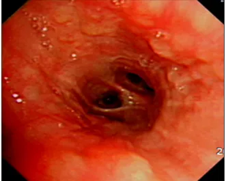 Figure 5. Biopsy of endobronchial nodules showed diffuse granulomatous  inflammation  with  multinucleated  giant  cells  (H&amp;E  stain,  ×100).