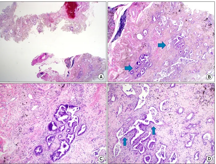 Figure 2. Pathologic findings of the surgical lung biopsy specimen and microscopic findings upon hematoxylin and eosin staining