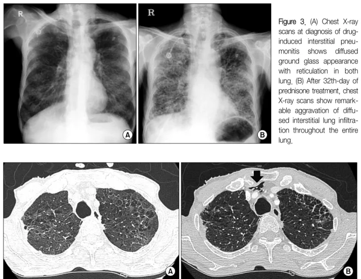 Figure  3.  (A)  Chest  X-ray  scans at diagnosis of  drug-induced  interstitial   pneu-monitis  shows  diffused  ground  glass  appearance  with  reticulation  in  both  lung