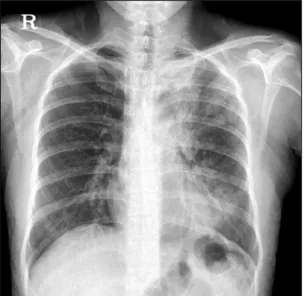 Figure  1.  Initial  chest  radiography  shows  diffuse  patchy  consolidations with geographic ground glass opacities in the  left  upper  and  lower  lung  fields.