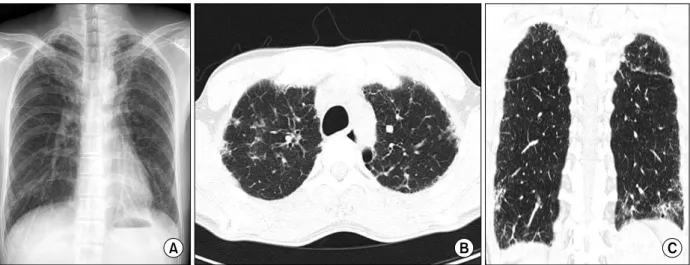 Figure 2. Chest X-ray and computed tomography taken on the first visit.  (A) Fibrostreaky and reticular patterned infiltration at  both  lung  fields