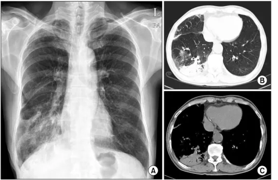 Figure  1.  (A)  Chest  X-ray  showed  increased   opac-ities in the right lower lobe