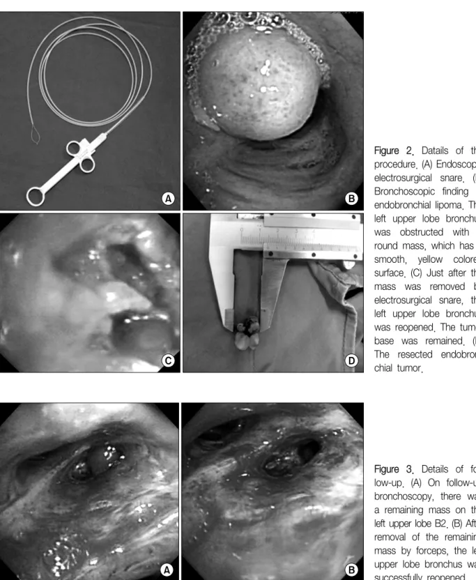 Figure  2.  Datails  of  the  procedure.  (A)  Endoscopic  electrosurgical  snare.  (B)  Bronchoscopic  finding  of  endobronchial  lipoma