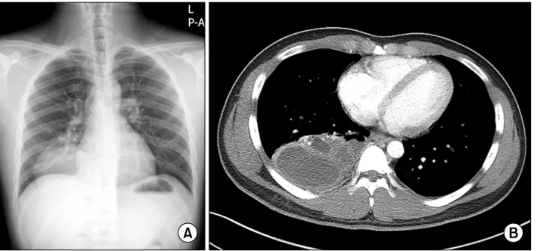 Figure  2.  A  cutting  plane  of  the  resected  lung  specimen shows  massive  cavitation  with  multiloculated  cysts  of  varying  size  within  the  lesion.