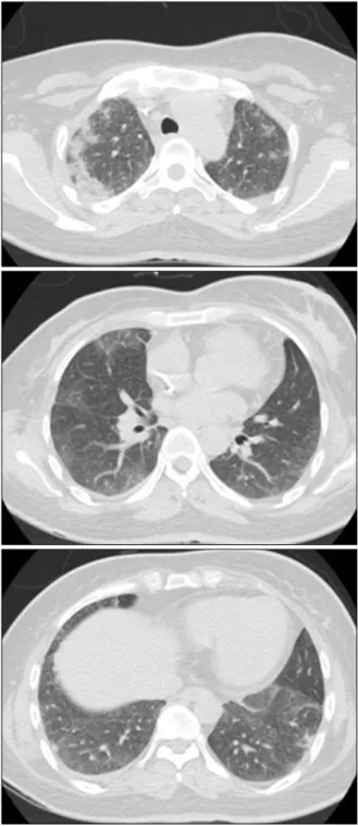 Figure 1. Chest X-ray showing a suspicious consolidation in the right upper lung field and diffuse bilateral haziness.