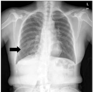 Figure  1.  Simple  chest  radiography  on  admission.  A  patch  of  opacity  is  seen  in  the  right  lower  lung  field  (arrow).