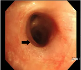 Figure  3.  Bronchoscopic  examination.  The  right  middle  lobe  (RML)  bronchus  is  not  seen  on  bronchoscopic   ex-amination  and  there  is  a  suspicious  dimpling  lesion  (arrow)  in  the  proximity  of  the  RML  bronchus.