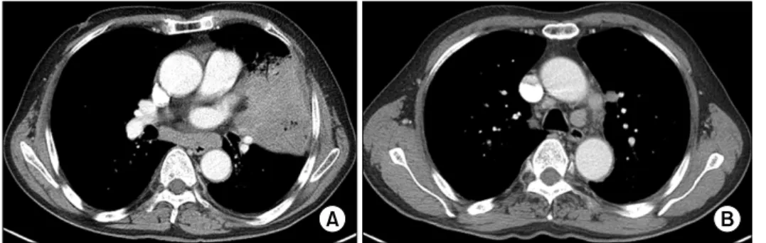 Figure  2.  Contrast  enhan- enhan-ced  computed   tomogra-phy  showed  consolidation  in  the  lingual  segment  of  left  upper  lobe  (A)  and   bi-lateral  meditational  lymph  nodes  swelling  (B).