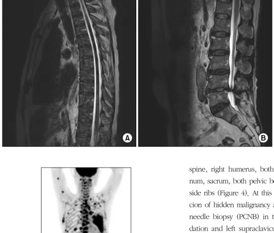 Figure  3.  Magnetic  reso- reso-nance imaging of the  thor-acic  (A)  and  lumbar  (B)  spine showed diffuse  heter-ogenous low signal change with  heterogenous   enhan-cement.