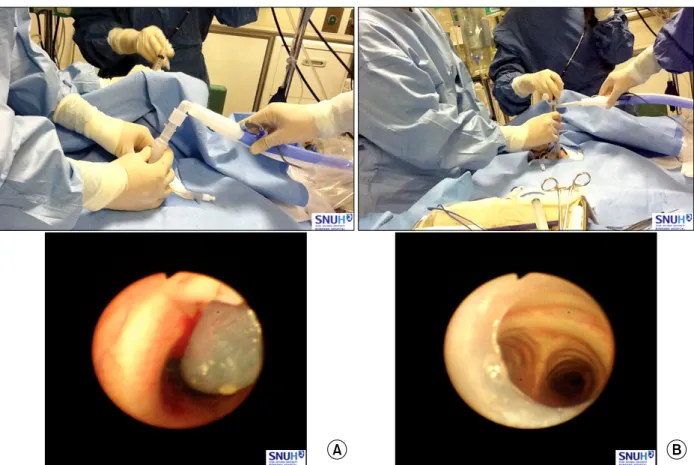 Figure 11. Checking T-tube insertion from above before E-tube removal immediately after the procedures (A)