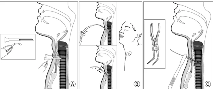 Figure  1.  Methods  of  percutaneous  tracheostomy  used  before  Ciaglia's  technique