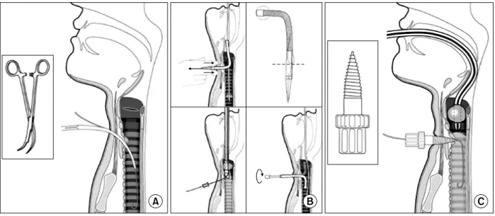 Figure  3.  Post-Ciaglia's  technique  attempted  for  percutaneous  tracheostomy.  (A)  Griggs  1990,  (B)  Fantoni  1993,  (C)
